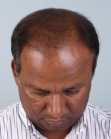 Before Hair Transplant&nbsp;Front